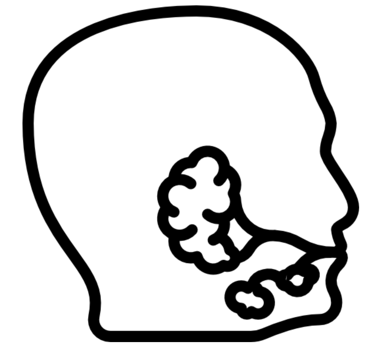 Salivary Gland Disease