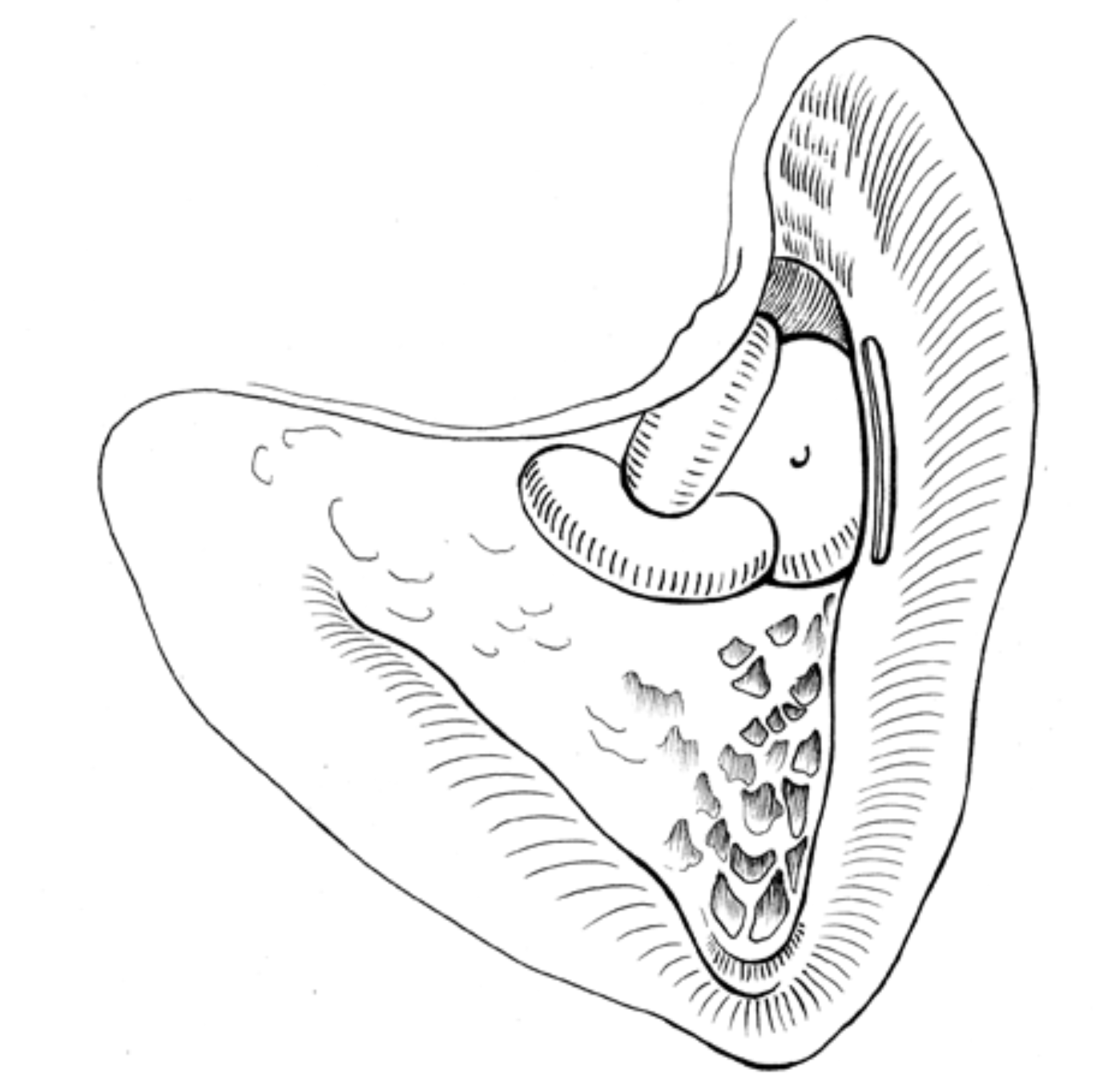 Superior Semicircular Canal Dehiscence