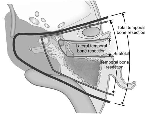 Temporal Bone Malignancy